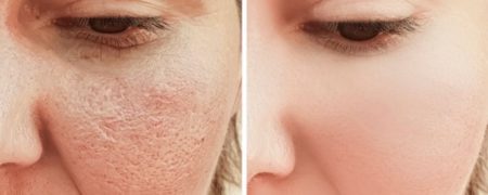 ۷ توصیه متخصصان برای کوچک کردن منافذ پوست