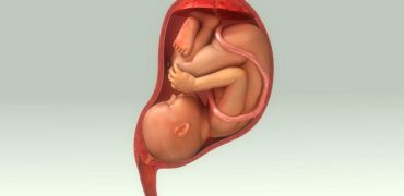 سرکلاژ دهانه رحم چیست و چرا دهانه رحم را می‌دوزند یا بخیه می‌زنند؟