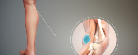 کیست بیکر چیست و چگونه درمان می شود؟