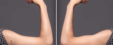 جراحی لیپوماتیک چیست و برای چه کسانی مناسب است؟