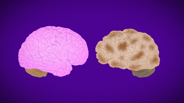 مغز و آلزایمر