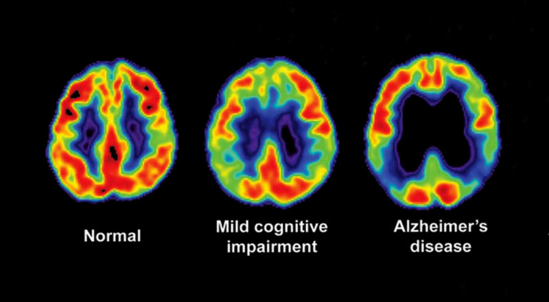 مغز و آلزایمر