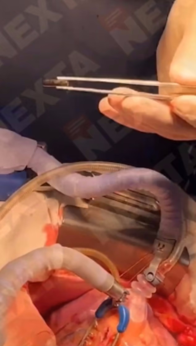 جراحان اوکراینی گلوله را از قلب سرباز مجروح بیرون کشیدند + ویدیو