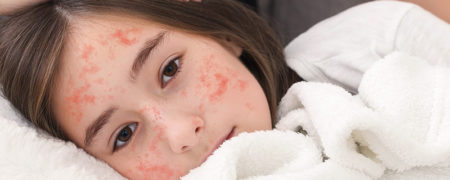 هشدار شیوع سرخک در کشور / چطور از این بیماری کشنده در امان بمانیم؟