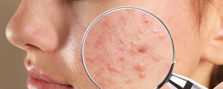 ۱۰ روش موثر درمان جوش و آکنه در خانه به توصیه پزشکان متخصص پوست