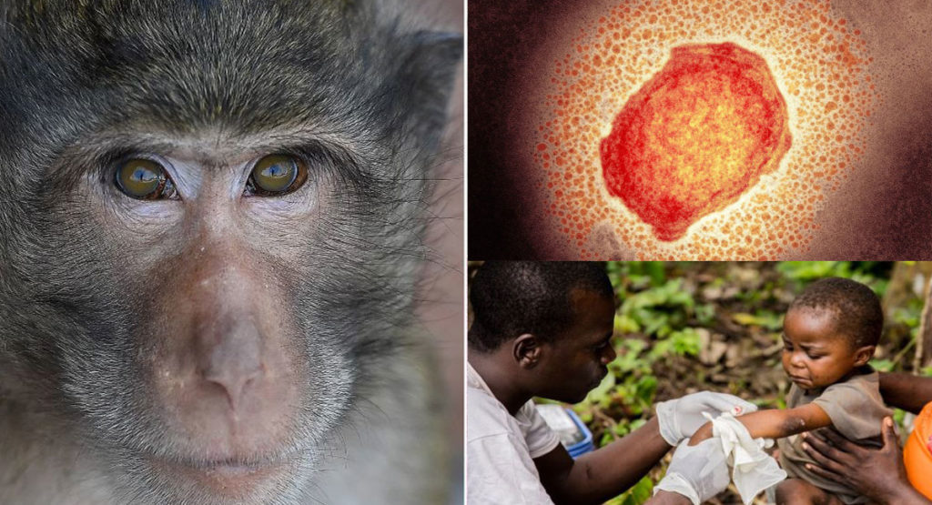 تفاوت ها و شباهت های علائم آبله میمون و بیماری زونا