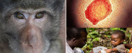 تفاوت ها و شباهت های علائم آبله میمون و بیماری زونا