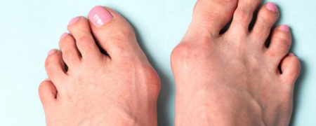 ۶ روش درمان هالوکس والگوس یا انحراف شست پا