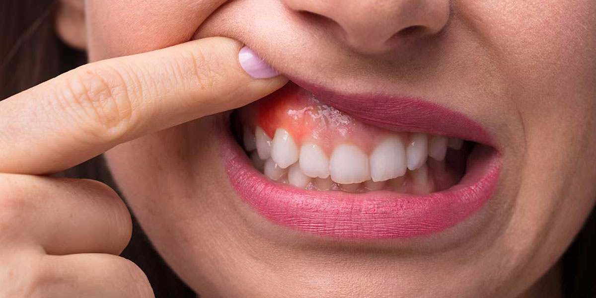 علائم سرطان دهان چیست؟