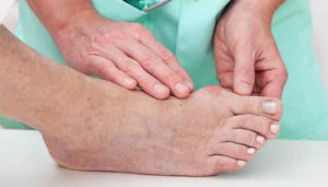 هالوکس والگوس یا بونیون عارضه‌ای است که در آن نوعی برجستگی استخوانی در کنار و انتهای شست پا ایجاد می‌شود.