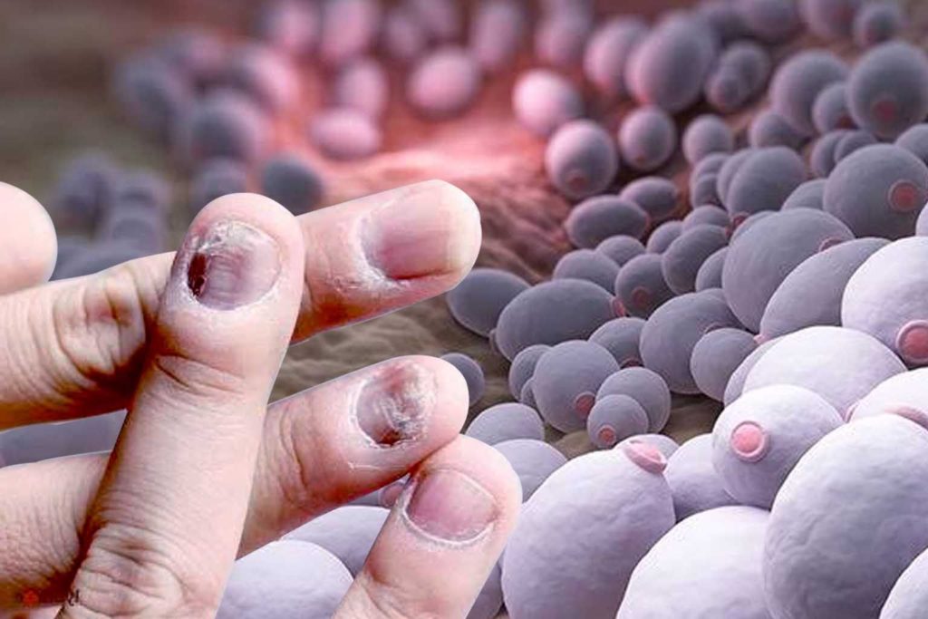 آیا می دانستید عفونت قارچی کشنده‌تر از سرطان و مالاریا است؟