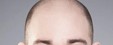 حکم دادگاهی در بریتانیا: «کچل» خطاب کردن مردان نوعی آزار جنسی است