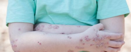 بیماری پروانه ای یا ای.بی چیست؟ با عوارض و نحوه درمان این بیماری آشنا شوید