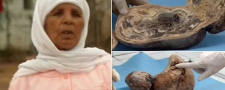 داستان زنی که پس از ۴۵ سال بارداری در نهایت یک نوزاد سنگی بدنیا آورد