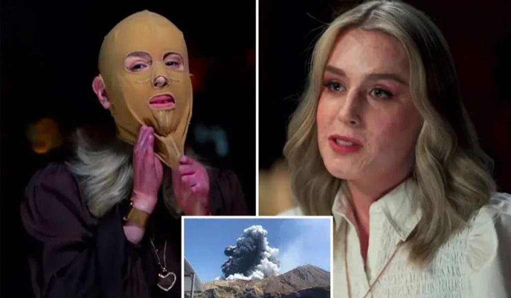 قربانی سوختگی ناشی از فوران آتشفشان برای اولین بار ماسک صورتش را بر می دارد + ویدیو