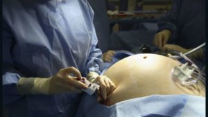 آیا امکان بارداری بعد از جراحی لاغری وجود دارد