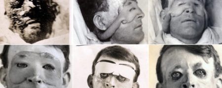 «پدر جراحی پلاستیک جهان» که به مجروحان جنگ جهانی اول زندگی دوباره می بخشید