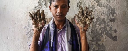 بیماری درختی چیست و چطور درمان می‌شود؟