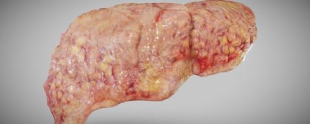 ۶ نشانه غیرقابل بازگشت بیماری کبد چرب ؛ از خارش و گیجی تا نفخ