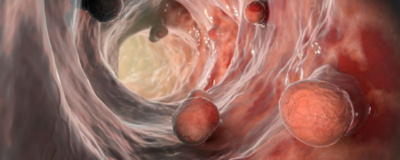 علائم غیرمعمول سرطان را بشناسید؛ از تعریق شدید شبانه تا نقاط ریز روی ناخن