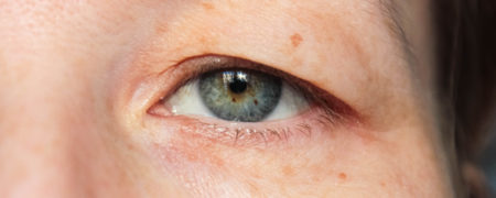 علت افتادگی پلک چشم چیست و چطور درمان می‌شود؟