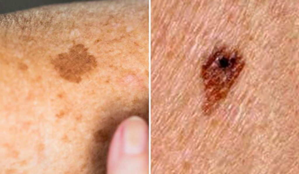 چگونه می توان تفاوت بین یک لکه پیری بی ضرر را با سرطان پوست تشخیص داد؟
