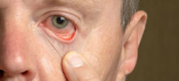 سندرم خشکی چشم چیست؟