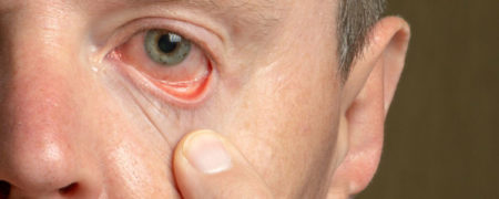 چه عواملی باعث سندرم خشکی چشم می شوند؟