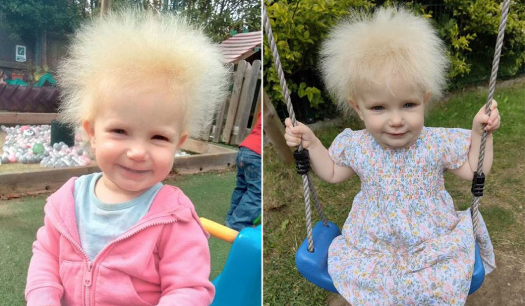 کودک ۱۷ ماهه‌ای که یکی از ۱۰۰ نفر مبتلا به سندرم موهای شانه نشدنی  است + ویدیو