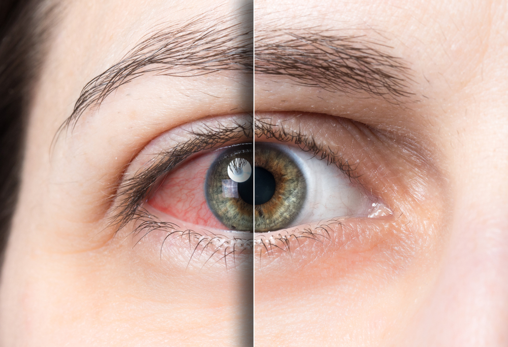 سندرم خشکی چشم چیست؟