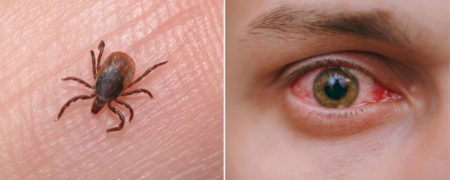 تب کریمه کنگو ؛ ویروسی که باعث خونریزی چشم و مرگ یک سوم مبتلایان می شود