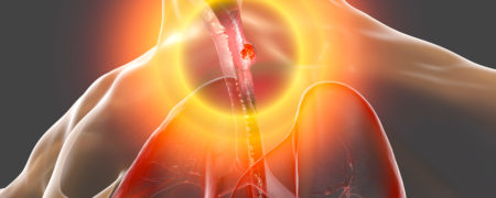 با بیماری مری بارت ، علائم و روش های درمان آن بیشتر آشنا شوید