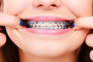 سوالات شما درباره ارتودنسی قبل از مراجعه به دندانپزشک!