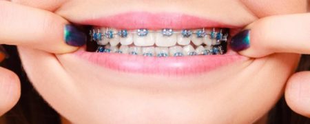 سوالات شما درباره ارتودنسی قبل از مراجعه به دندانپزشک!