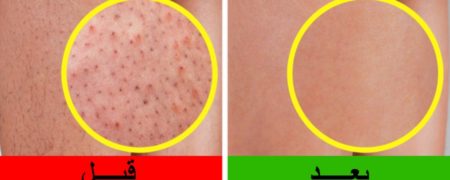 دانه دانه شدن پوست پا و راهکارهایی ساده و کاربردی برای رفع آن