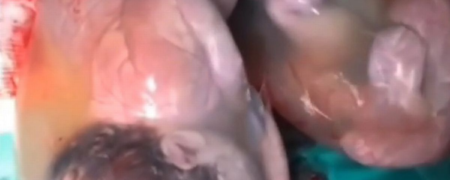 لحظه باورنکردنی تولد دوقلوها در کیسه‌ آمنیوتیک سالم! یک احتمال در هر ۸۰ هزار مورد