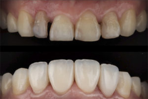 هر واحد کامپوزیت چند دندان است؟