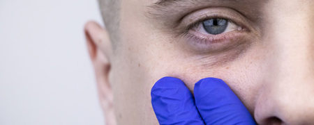 لیزر آر اف فرکشنال، بهترین لیزر برای سیاهی دور چشم