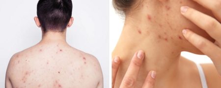 علت جوش در هر قسمت از بدن چیست؟