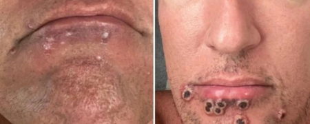 تصاویری که خط سیر روزانه علائم آبله میمونی را نشان می‌دهد