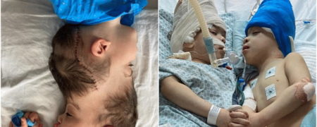 جداسازی موفقیت آمیز دوقلوهای به هم چسبیده توسط ۱۰۰ پزشک با تکنولوژی VR