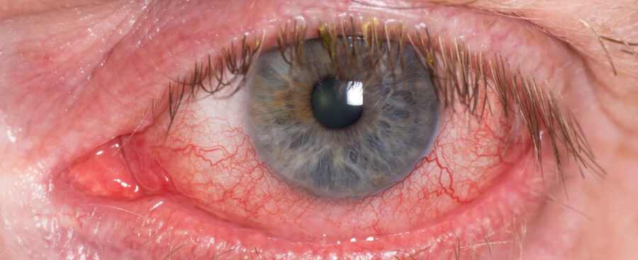 علائم چشمی کلسترول بالا کدامند؟