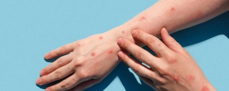 شناسایی اولین مورد ابتلا به آبله میمونی در کشور؛ فرد مبتلا کیست؟