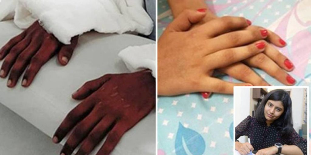 حیرت پزشکان از زنانه شدن دست های یک مرد پس از پیوند به دختر ۱۸ ساله