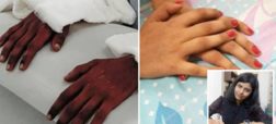 حیرت پزشکان از زنانه شدن دست های یک مرد پس از پیوند به دختر ۱۸ ساله