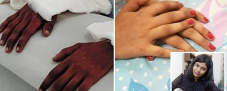 حیرت پزشکان از زنانه شدن دست های یک مرد پس از پیوند به دختر ۱۸ ساله