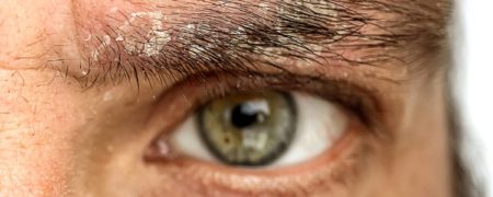 همه چیز درباره بیماری پوستی پسوریازیس