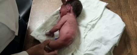 تولد یک نوزاد عجیب‌ الخلقه که به جای پا ساختاری دم‌مانند و شبیه شاخ دارد!