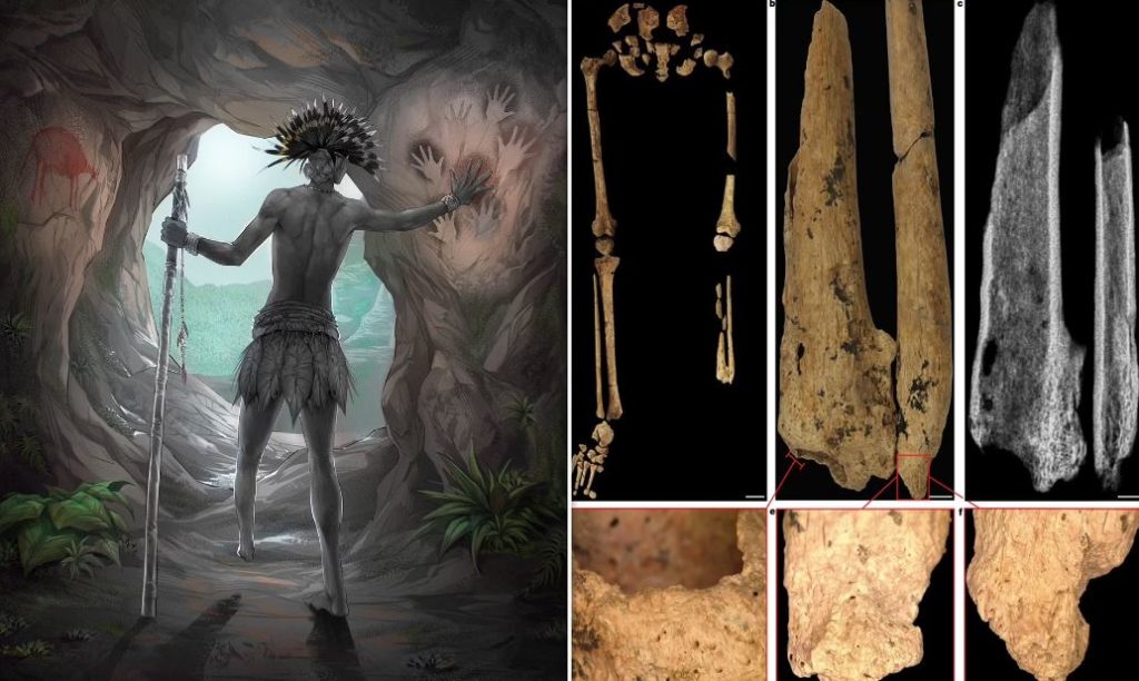 اولین جراحی قطع عضو تاریخ ؛ نوجوانی که ۳۱,۰۰۰ سال پیش پای چپش را به جراح سپرد