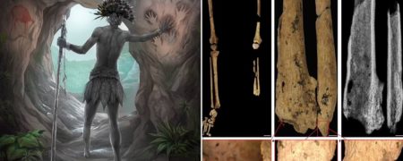 اولین جراحی قطع عضو تاریخ ؛ نوجوانی که ۳۱,۰۰۰ سال پیش پای چپش را به جراح سپرد
